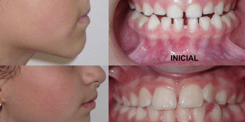 Tratamiento temprano con máscara facial