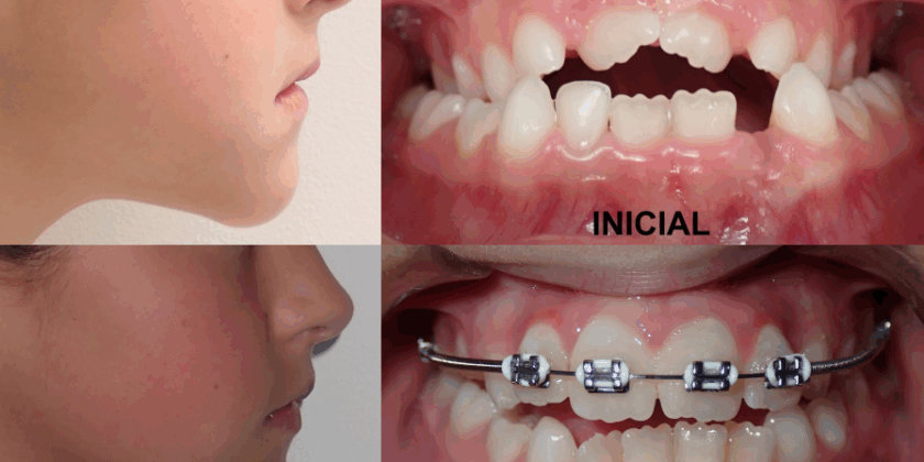 Tratamiento temprano con máscara facial